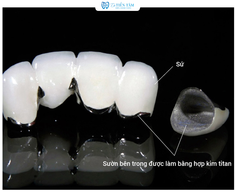 Mão răng sứ kim loại