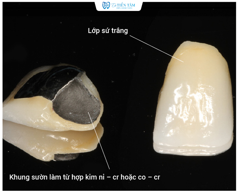 Răng sứ kim loại thường