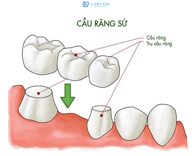 Bắt cầu răng sứ là gì?