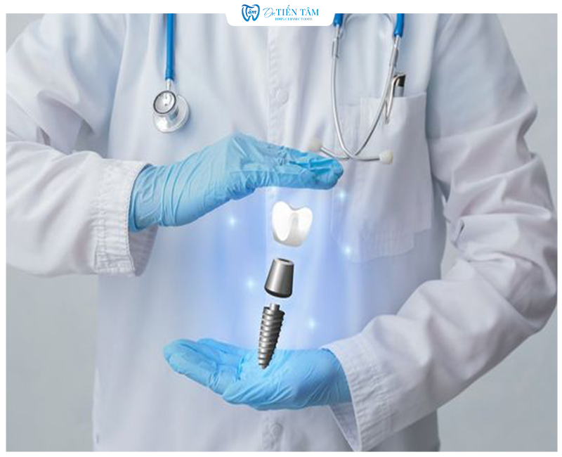 Quy trình cấy ghép Implant