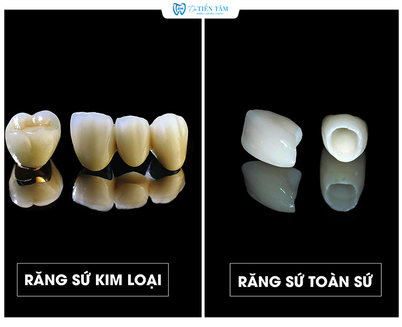 Răng sứ kim loại và Răng sứ toàn sứ