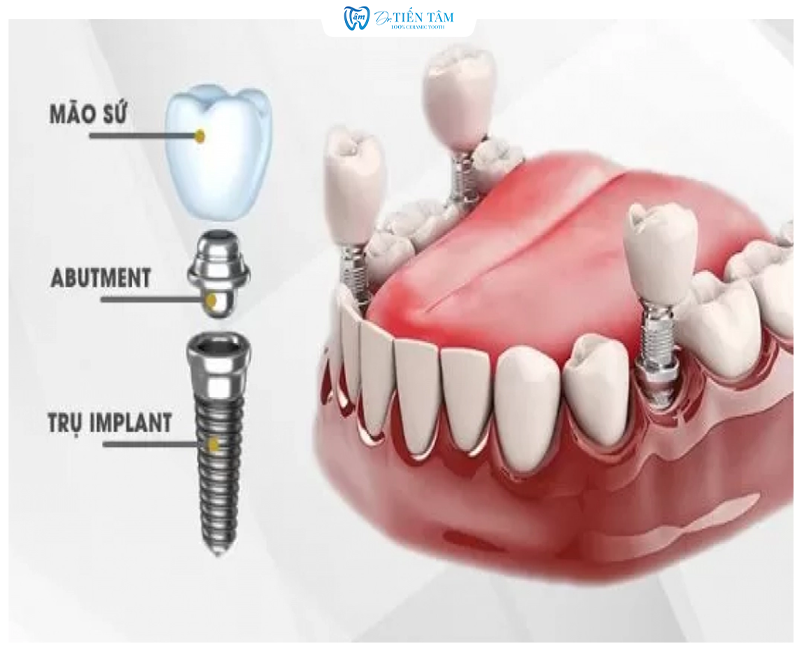 Cấy ghép Implant là gì?