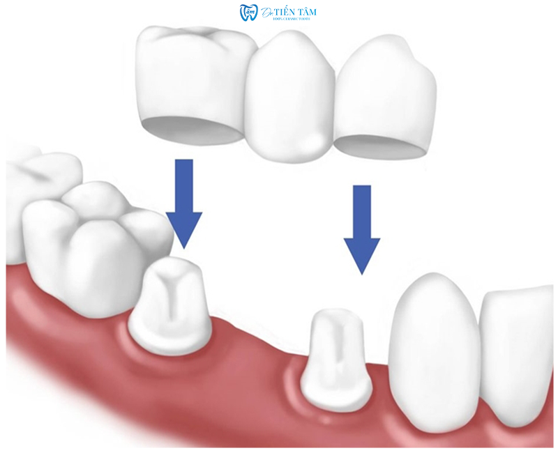 Cầu răng sứ truyền thống