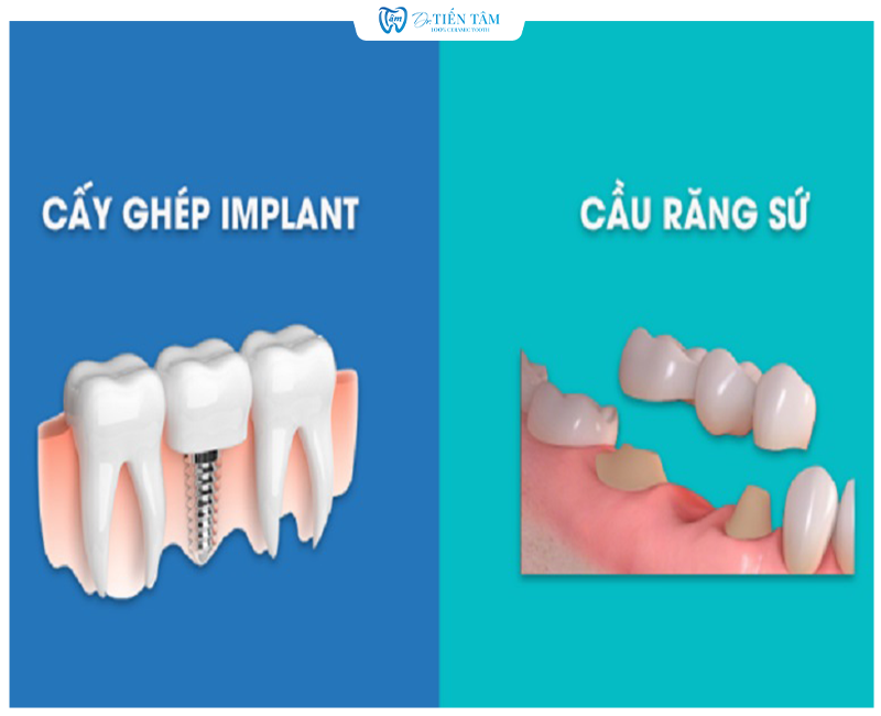 Phân biệt giữa làm cầu răng sứ và cấy Implant