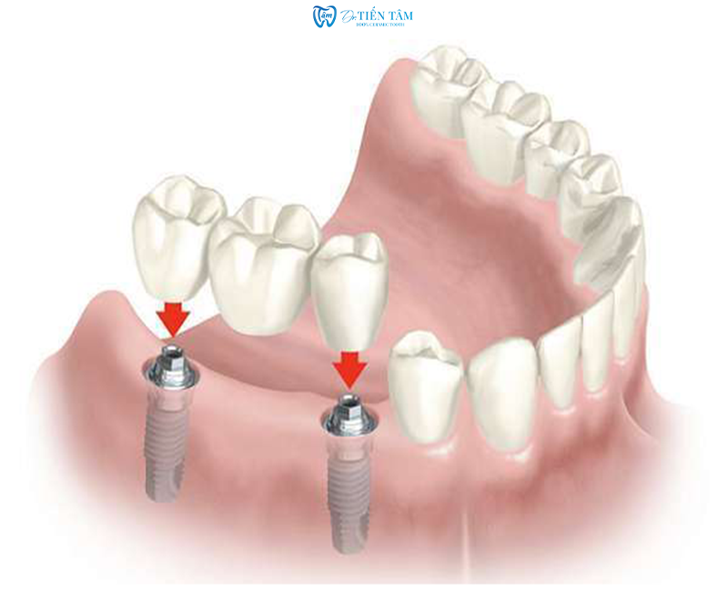 Cầu răng có Implant hỗ trợ