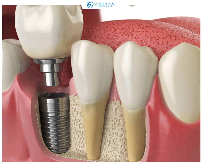 Cấy ghép Implant