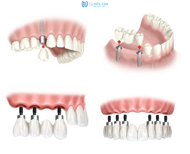 Đối tượng phù hợp với cấy ghép Implant