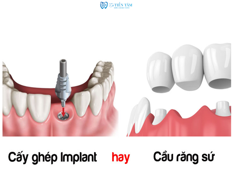 Mất răng nên làm cầu răng sứ hay cấy Implant