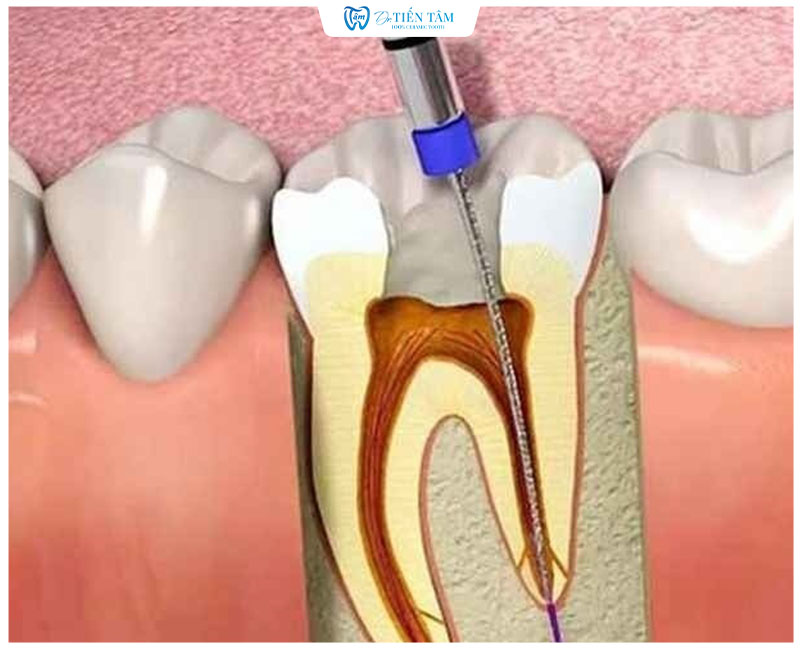 Răng chửa tủy sẽ bị giòn, dễ gẫy. Bọc sứ là phương pháp phù hợp bảo vệ răng