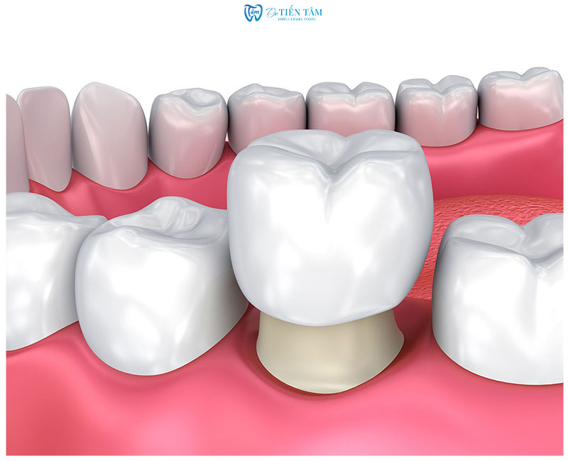 Bọc răng sứ là quy trình tạo 1 răng giá bằng sứ cho kích thước, màu sắc tương tự răng thật