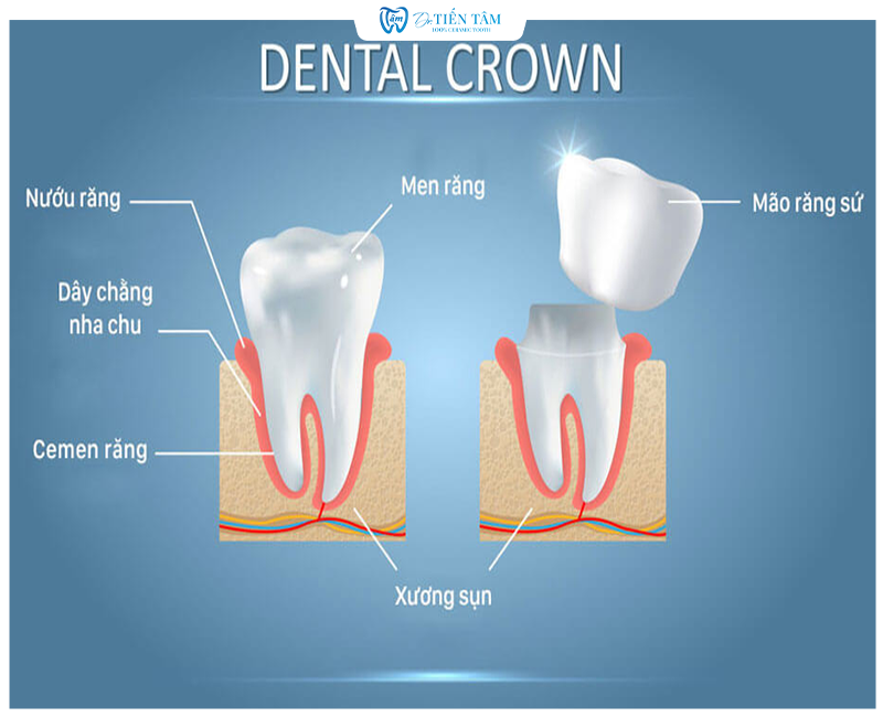 Bọc răng sứ là gì?