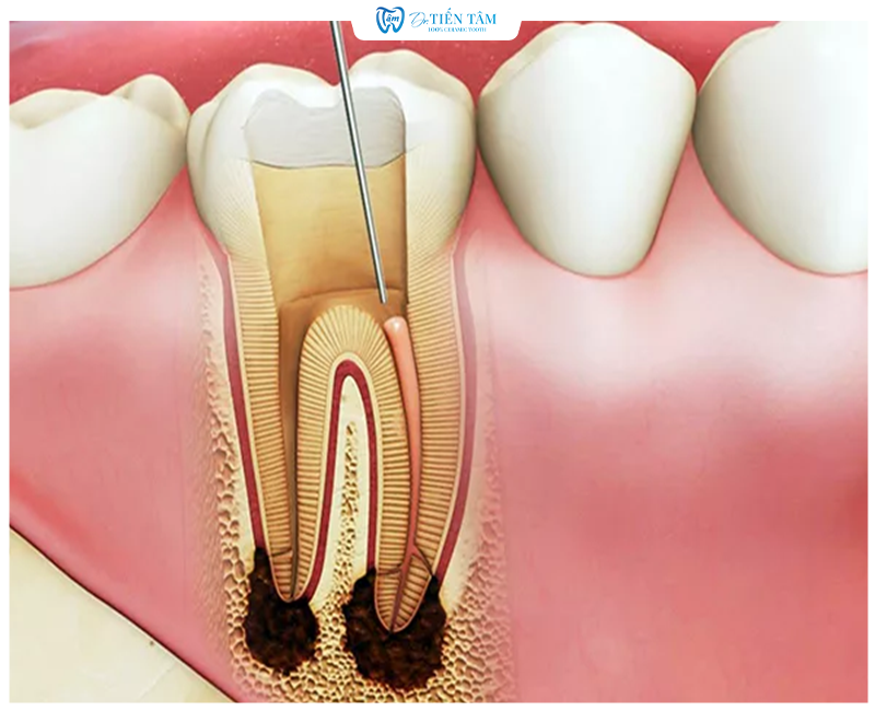 Răng bị sâu nặng, nhiễm trùng trong xương