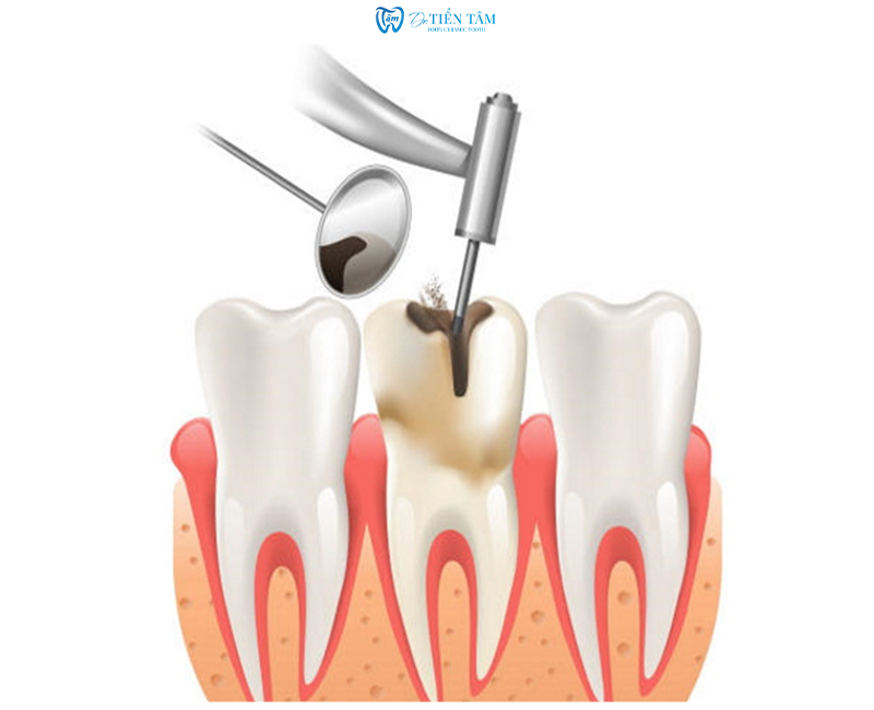 Bọc răng sứ có lấy tuỷ không?